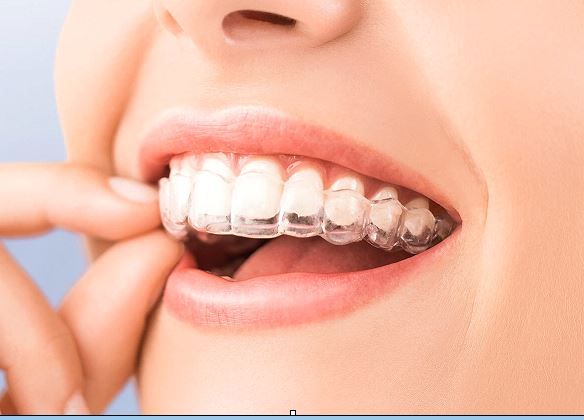 Clear Aligner Near Me In Jenkintown, PA - Best Dental Clinic For All Dental Treatment Near Me