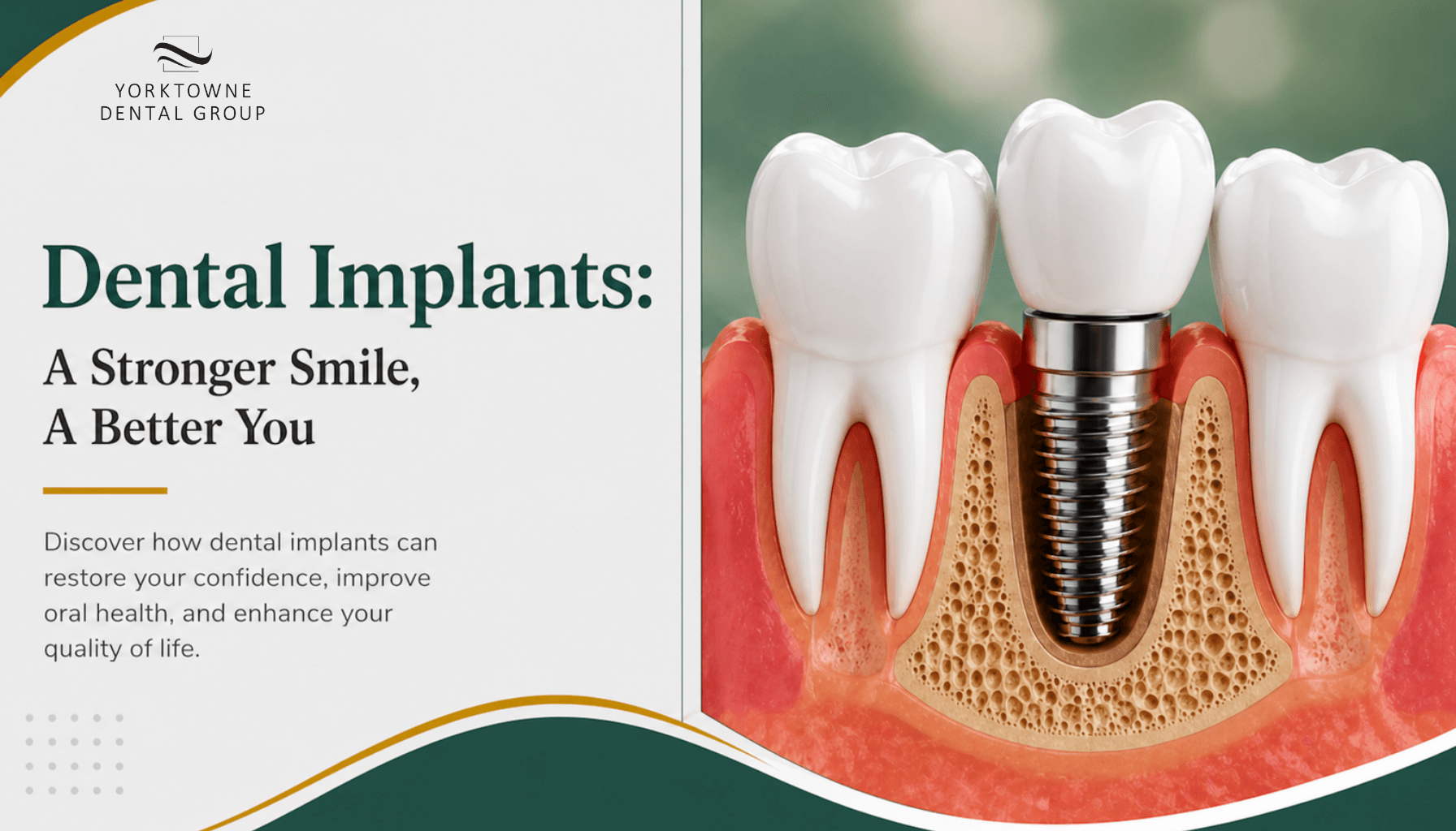 Discover the Benefits of Dental Implants