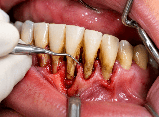 Periodontics Near Me In Jenkintown, PA - Best Dental Clinic For All Dental Treatment Near Me