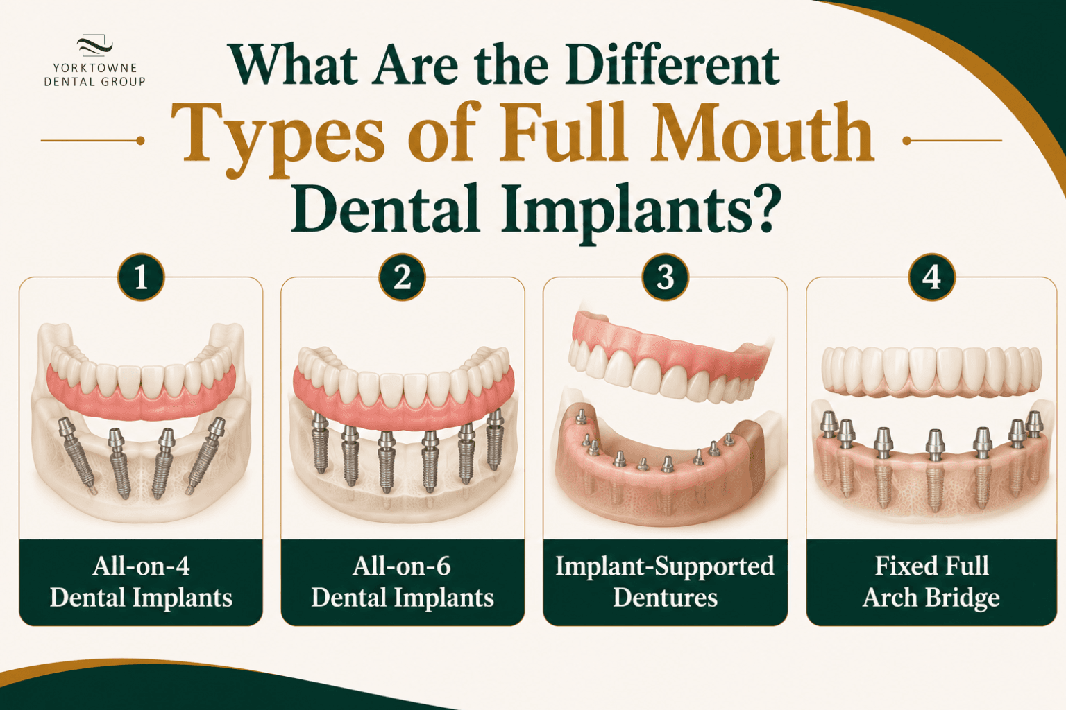 What Are the Different Types of Full Mouth Dental Implants.png What Are the Different Types of Full Mouth Dental Implants.png