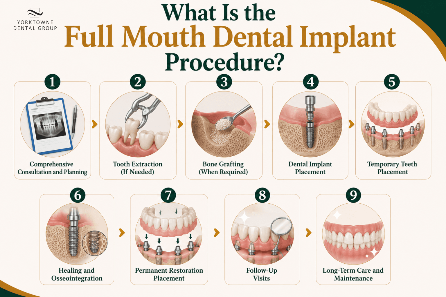 What Is the Full Mouth Dental Implant Procedure.png What Is the Full Mouth Dental Implant Procedure.png