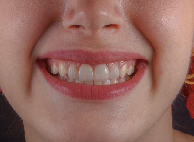 Dental Implants.