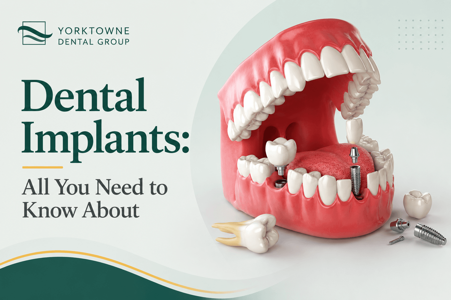 Dental Implants: All You Need to Know About