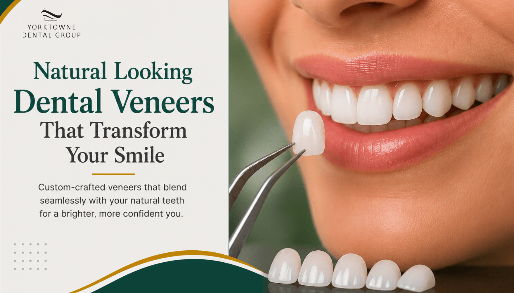 Natural Looking Dental Veneers That Transform Your Smile